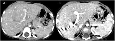 Portal Vein Embolization for Future Liver Remnant Enhancement and Combined Modality Treatment for the Management of Post-hepatic Resection Biliary Fistula in an 18-Month Old Child With Hepatoblastoma